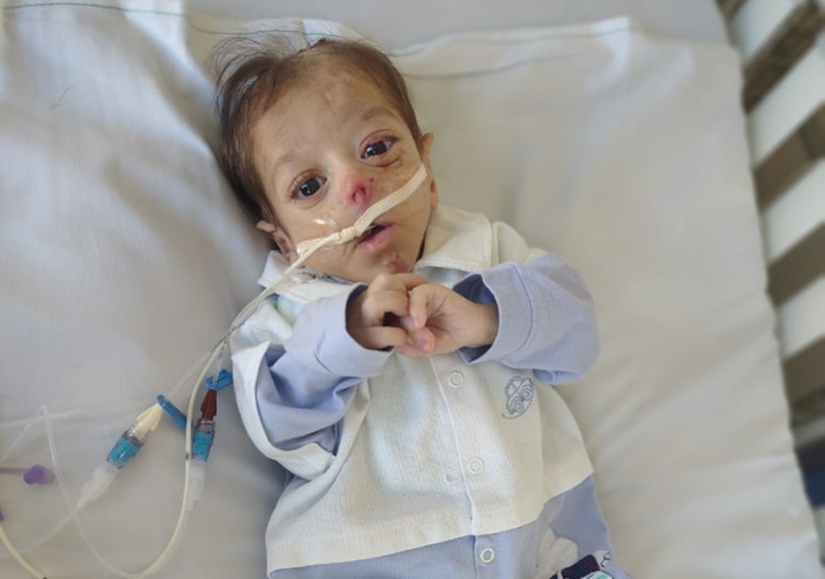 Batalha pela vida: Ravi, bebê de Guarulhos, enfrenta desafios de uma rara cardiopatia congênita