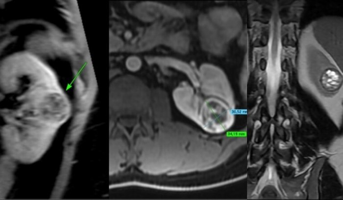 "Gabriel, de 30 anos, luta contra câncer renal e precisa de apoio para cirurgia robótica urgente"