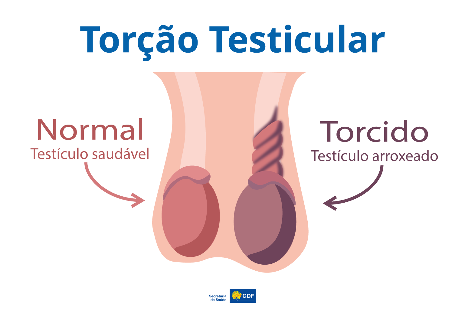 Torção testicular: condição grave que pode levar à perda do testículo se não tratada rapidamente
