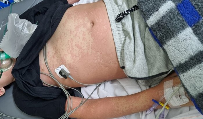 "Campanha busca apoio para tratamento de imunoterapia após choque anafilático em criança picada por abelha"
