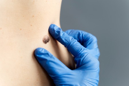 Pesquisadores brasileiros identificam quatro genes que preveem resistência à imunoterapia em pacientes com melanoma