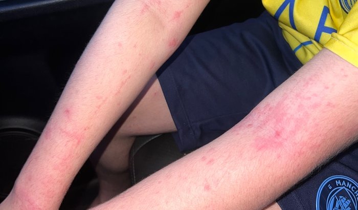 "Campanha busca arrecadar R$ 24 mil mensais para tratamento urgente de dermatite atópica em criança"
