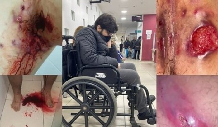Victor luta contra a Hidradenite Supurativa em estágio avançado e precisa de ajuda para cirurgia urgente
