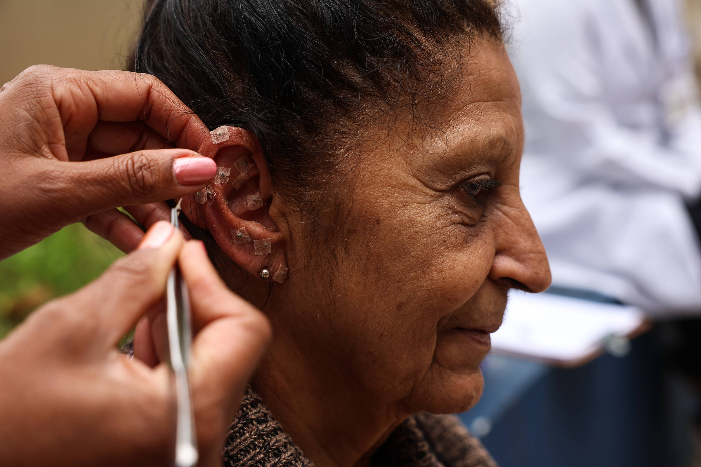 Auriculoterapia transforma vidas na UBS Jardim Colombo, aliviando dores e melhorando o sono de pacientes