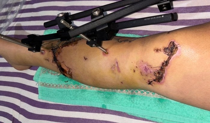 Mariana Polizelli inicia jornada de recuperação após grave acidente que impactou sua saúde e rotina