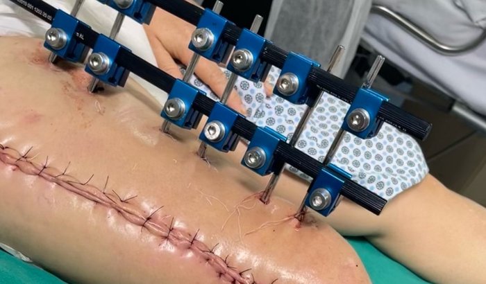 "Cleonice busca apoio para tratamento de osteomielite após grave acidente que a deixou com fraturas múltiplas"
