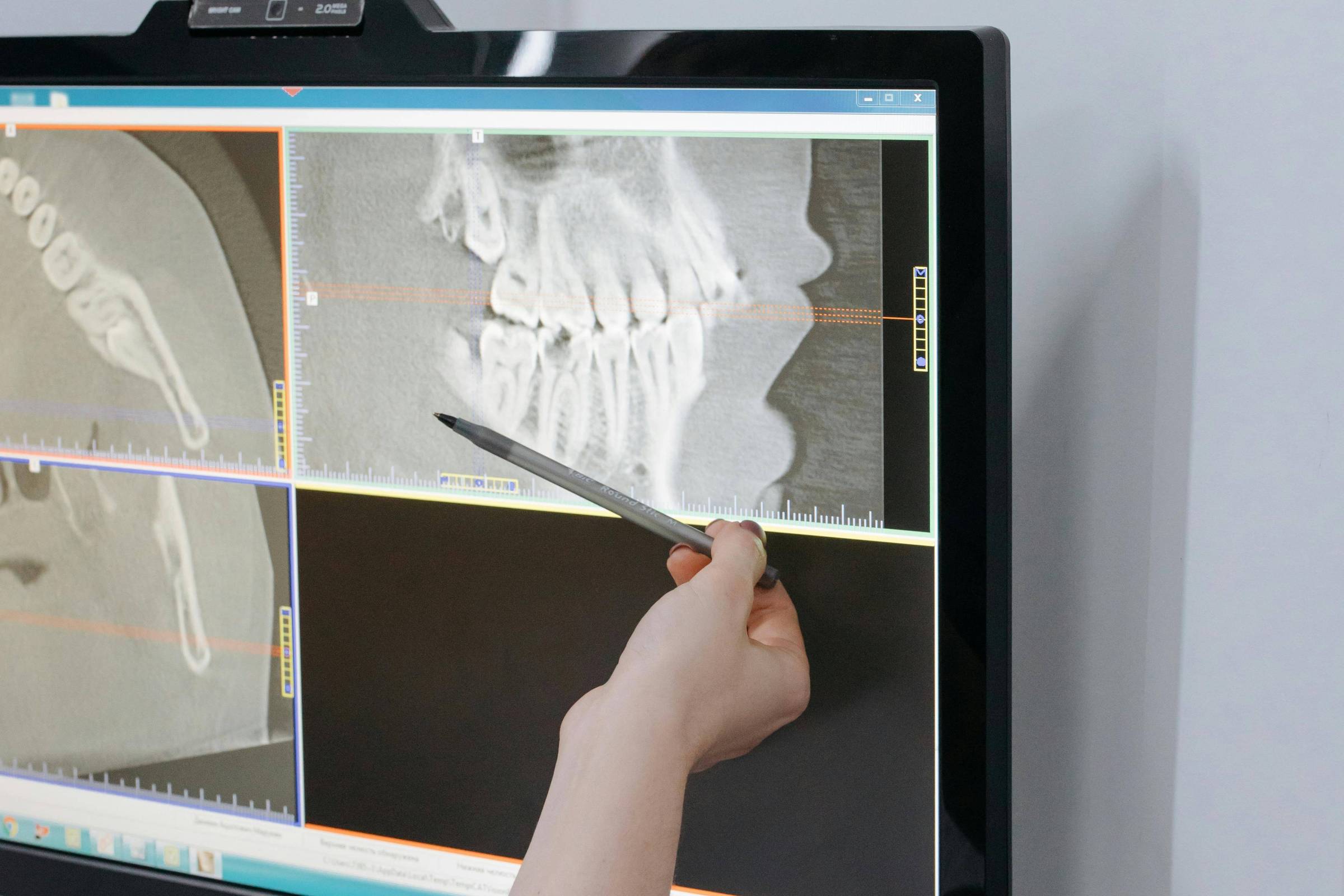 Método inovador reduz estágios degenerativos da articulação temporomandibular com técnica menos invasiva