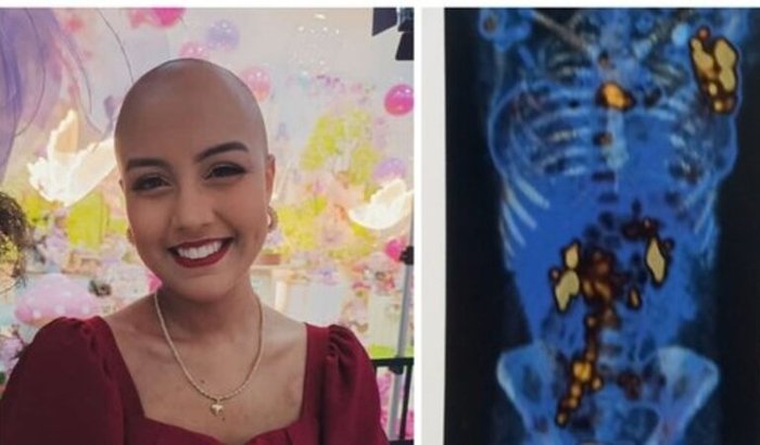 "Adriele enfrenta nova batalha contra infecção após transplante de células-tronco e convulsão"