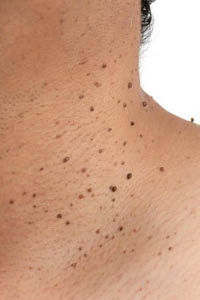 Close up of a neck with a lot of dark coloured skintags