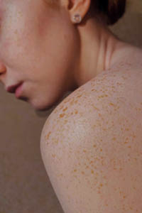 Close up of a fair skinned woman with freckles and pigmentation on her face and shoulder.