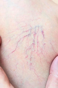 Close up of spider veins on a leg framed by fingers