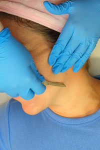 Woman receiving a dermaplaning treatment at Complexion Medspa Cobourg