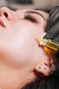 Closeup of a woman receiving a PRP Vampire Facial injection at Complexion Medspa