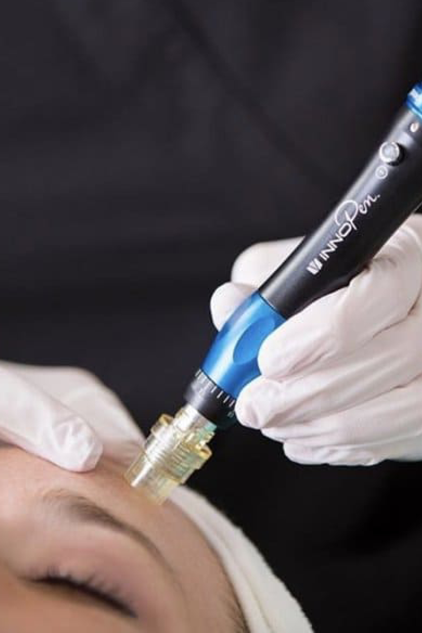 Micro needling InnoPen placed against a woman's forehead wiith a gloved hand