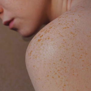 Close-up of a person's shoulder and upper back with visible freckles and smooth skin.