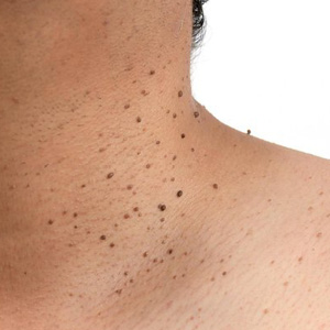 Close-up of a person's neck and shoulder with multiple small skin tags and moles.