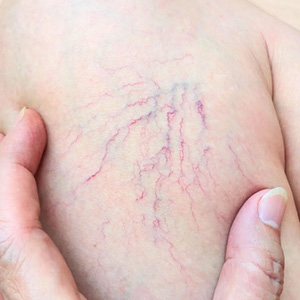 Close-up of skin showing visible spider veins with a hand gently pressing the area.
