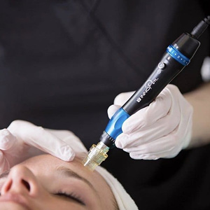 Close-up of a microneedling device being used on a person's forehead by a gloved professional.