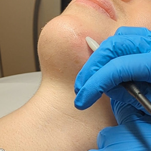 Close-up of a gloved hand performing electrolysis hair removal on a person's chin.