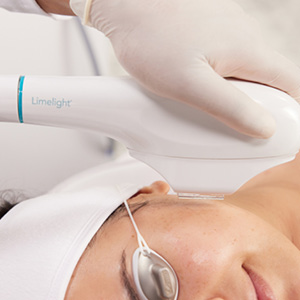 Close-up of a gloved hand holding a Limelight IPL device near a woman's face wearing protective eye shields during a skin treatment.