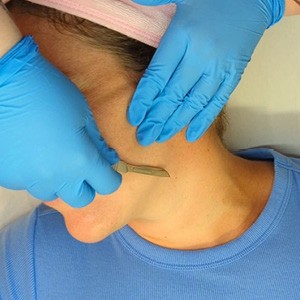 Close-up of a person receiving dermaplaning treatment with a razor blade by hands in blue gloves.