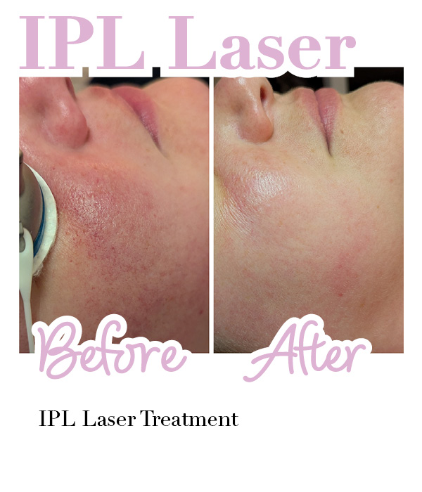 Side-by-side close-up of a woman's face before and after a Platinum Hydrafacial with Dermabuilder Booster, showing smoother, more radiant skin post-treatment.