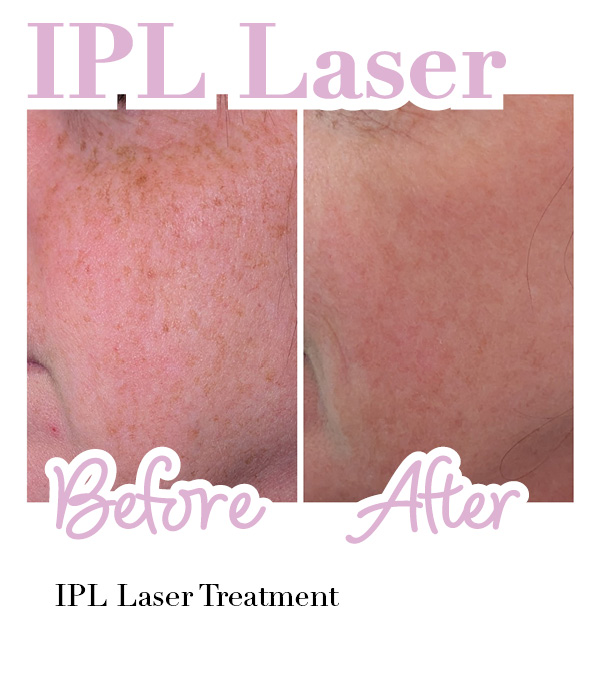 Side-by-side comparison of a woman's cheek before and after a Platinum Hydrafacial treatment with Hydrafilic Pep9 Booster, showing smoother and more hydrated skin in the after image.