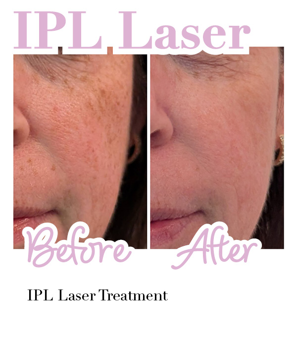 Side-by-side comparison of a woman's cheek before and after a Platinum Hydrafacial treatment with Hydrafilic Pep9 Booster, showing smoother and more hydrated skin in the after image.