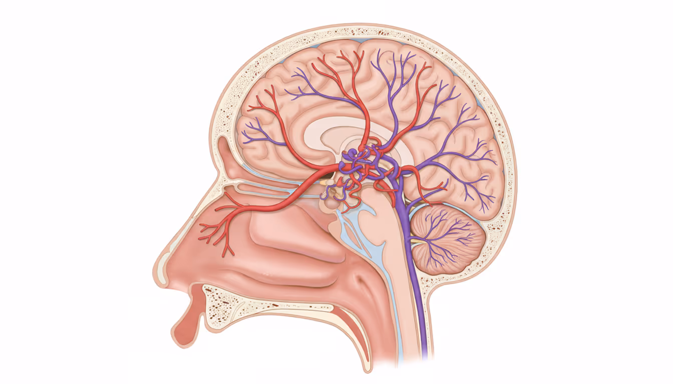 Arteriovenous malformation (AVM)