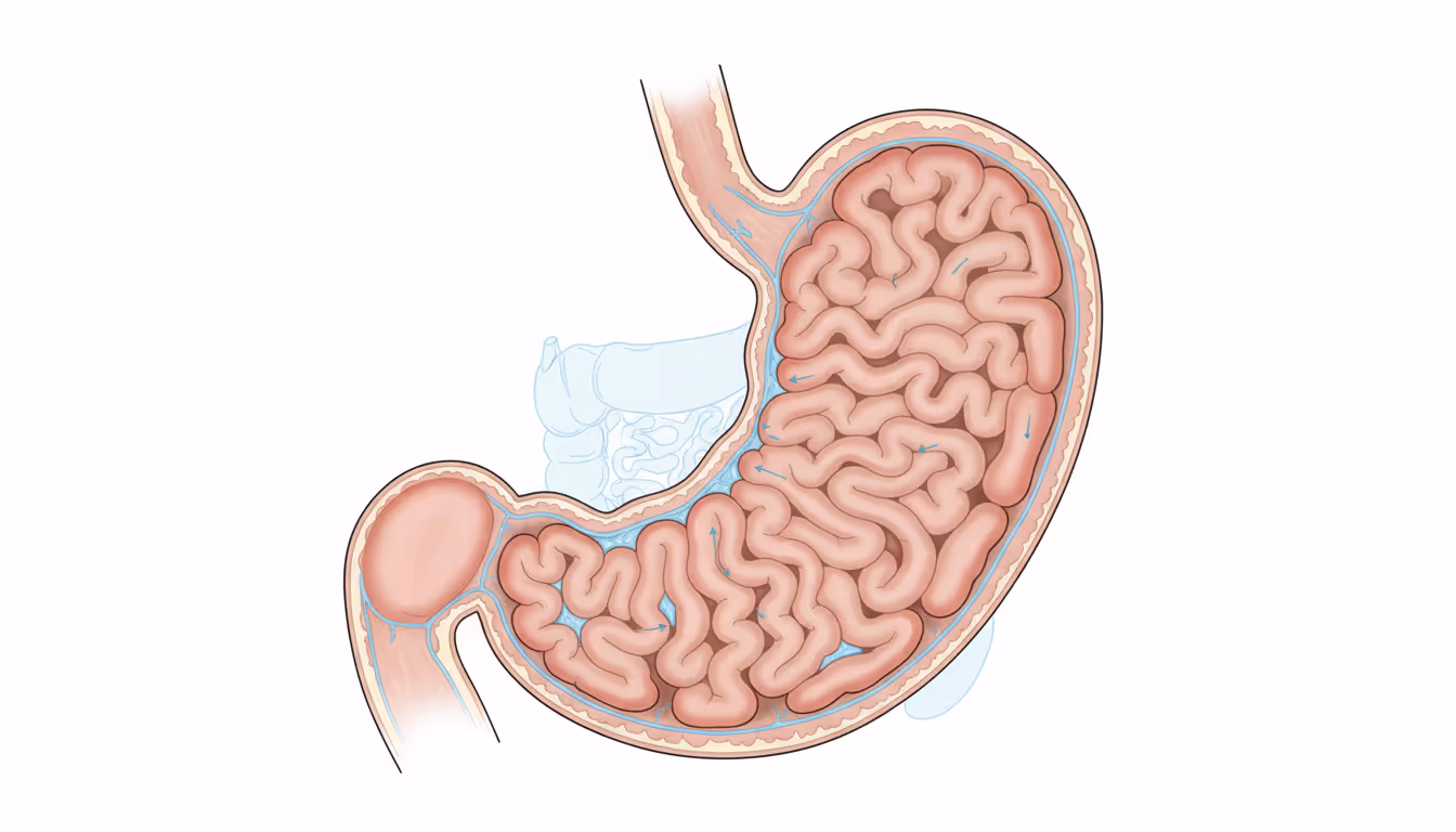 Giant hypertrophic gastritis