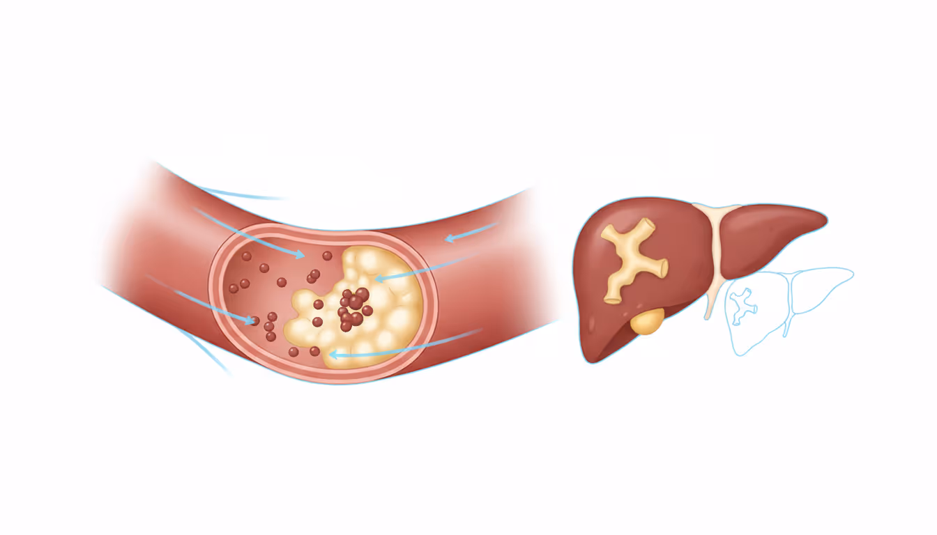 Hypercholesterolemia