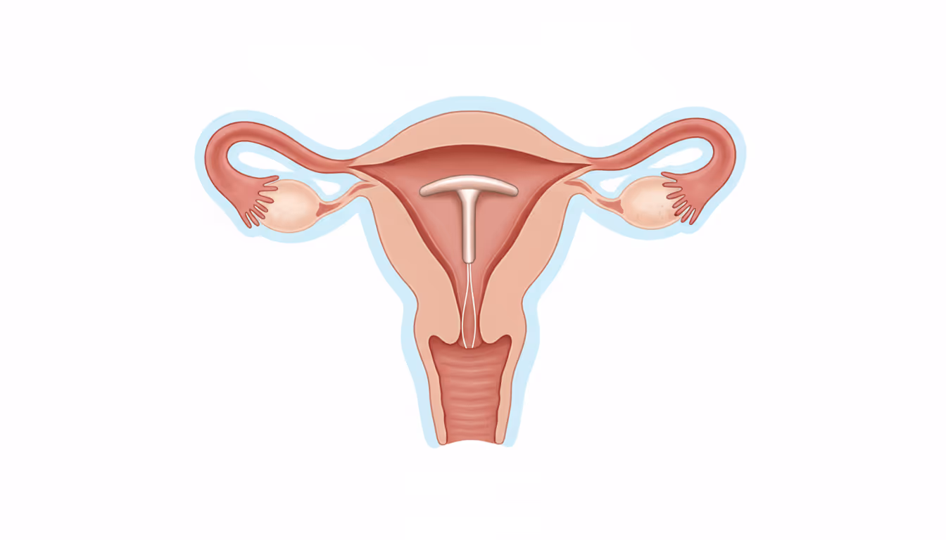 IUD (intrauterine contraceptive device)
