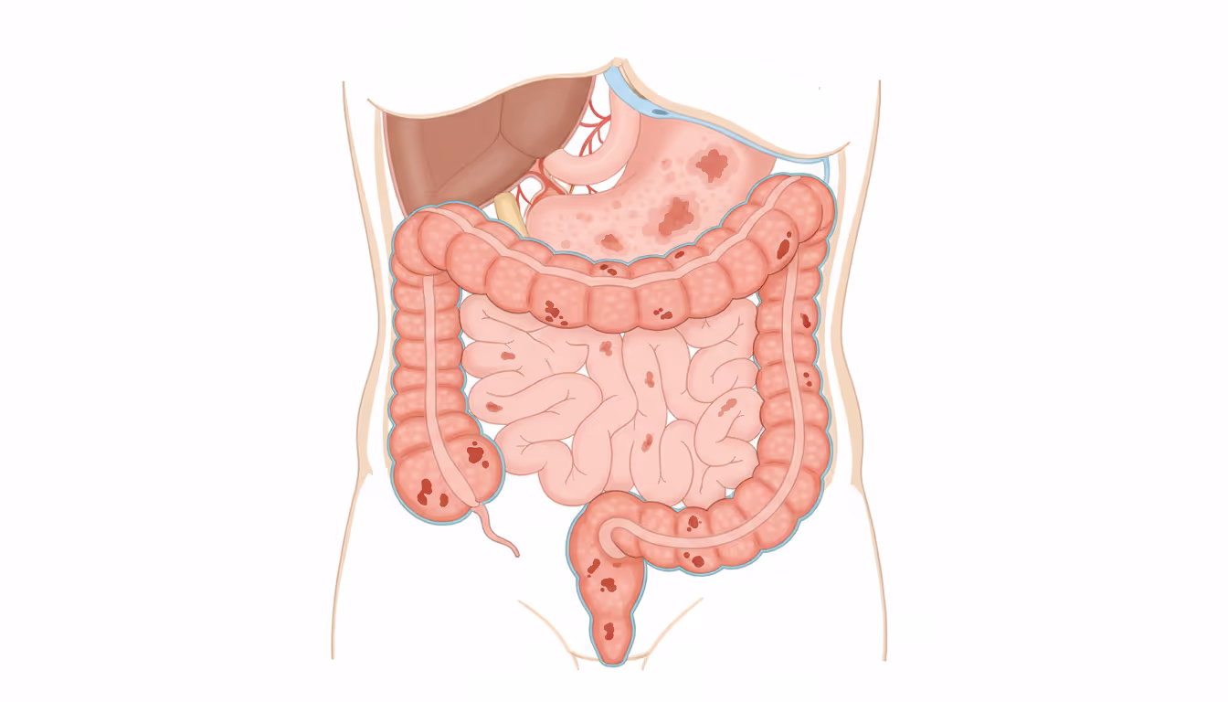 Pancolitis