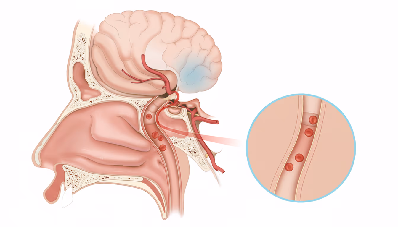 Transient ischemic attack (TIA, Mini-Stroke)