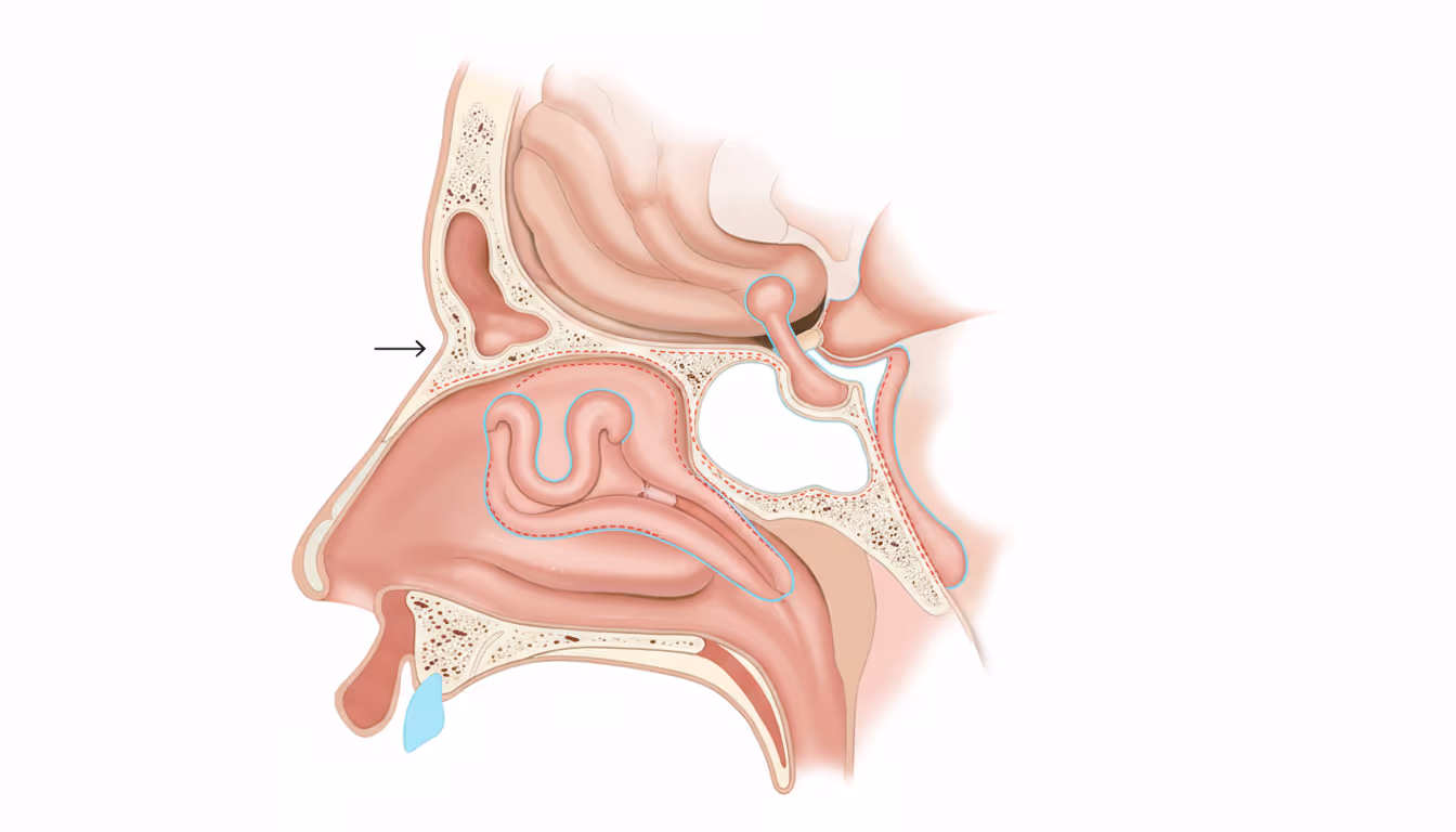 Uvulopalatopharyngoplasty