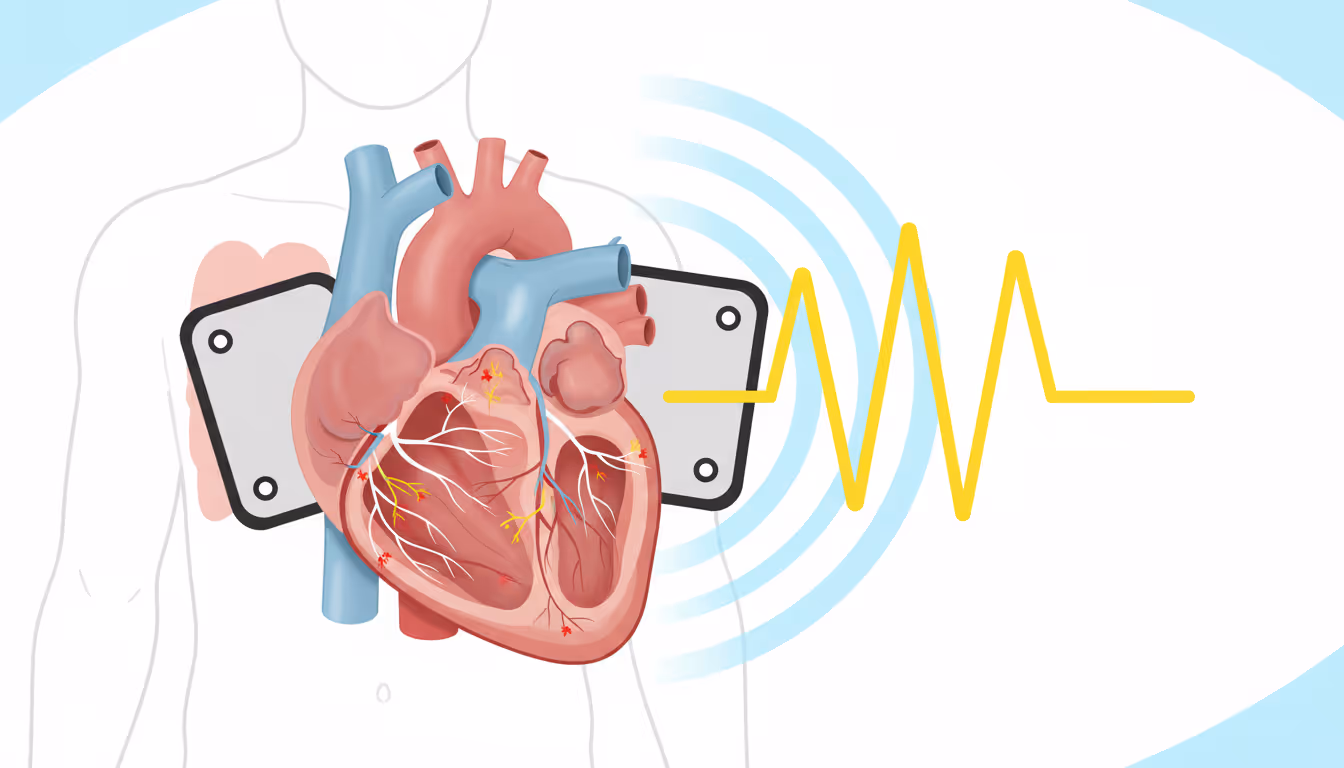 Sudden Cardiac Arrest (SCA)