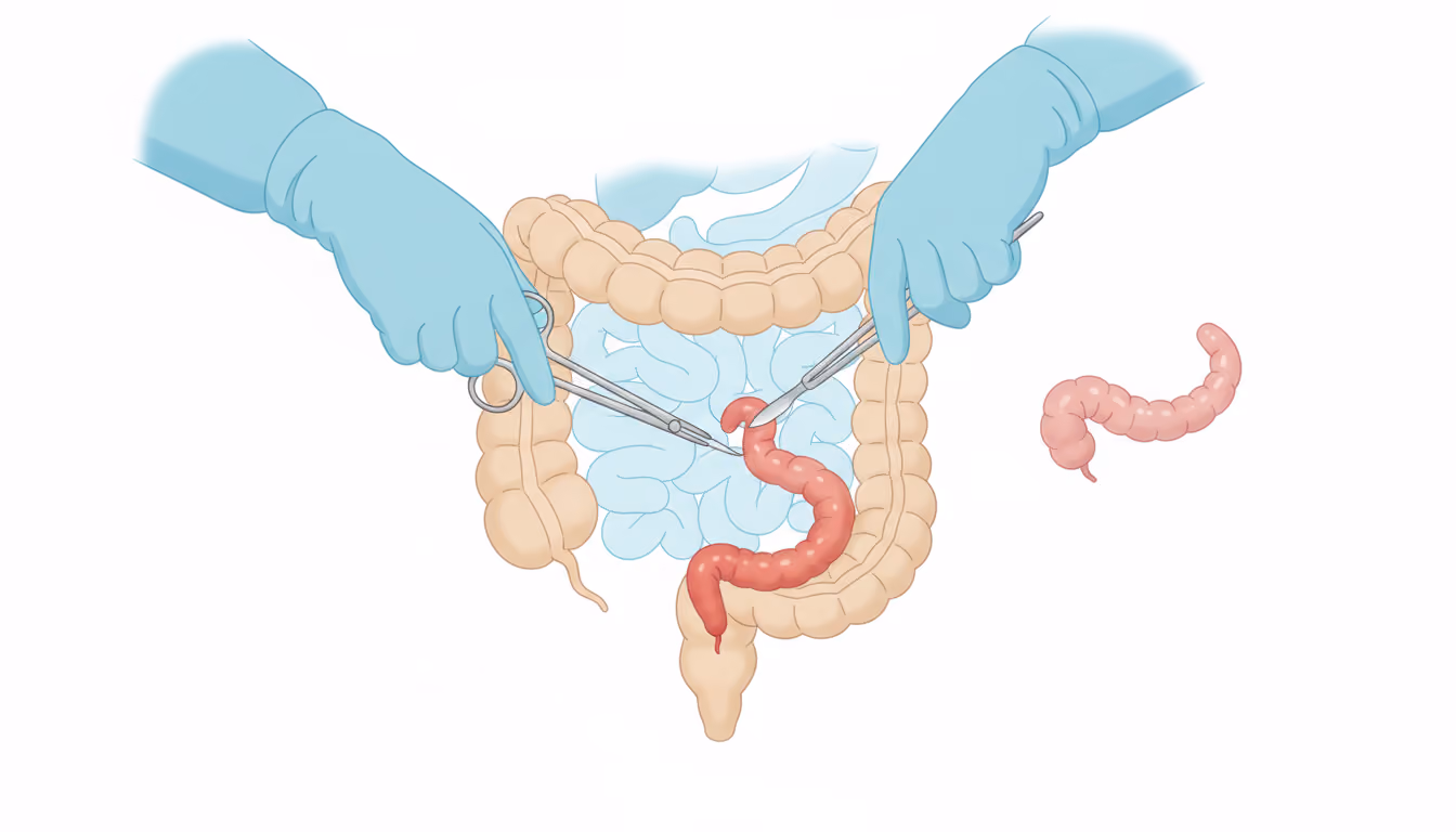 Appendectomy