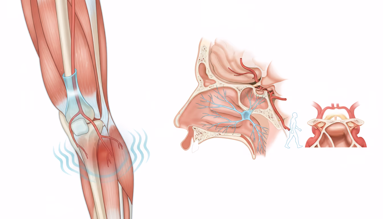 Intermittent claudication