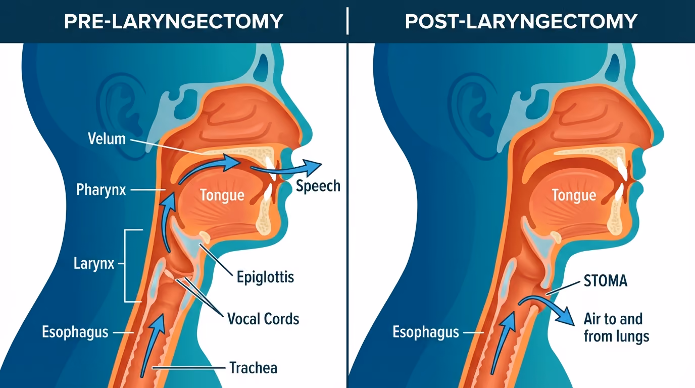 Laryngectomee