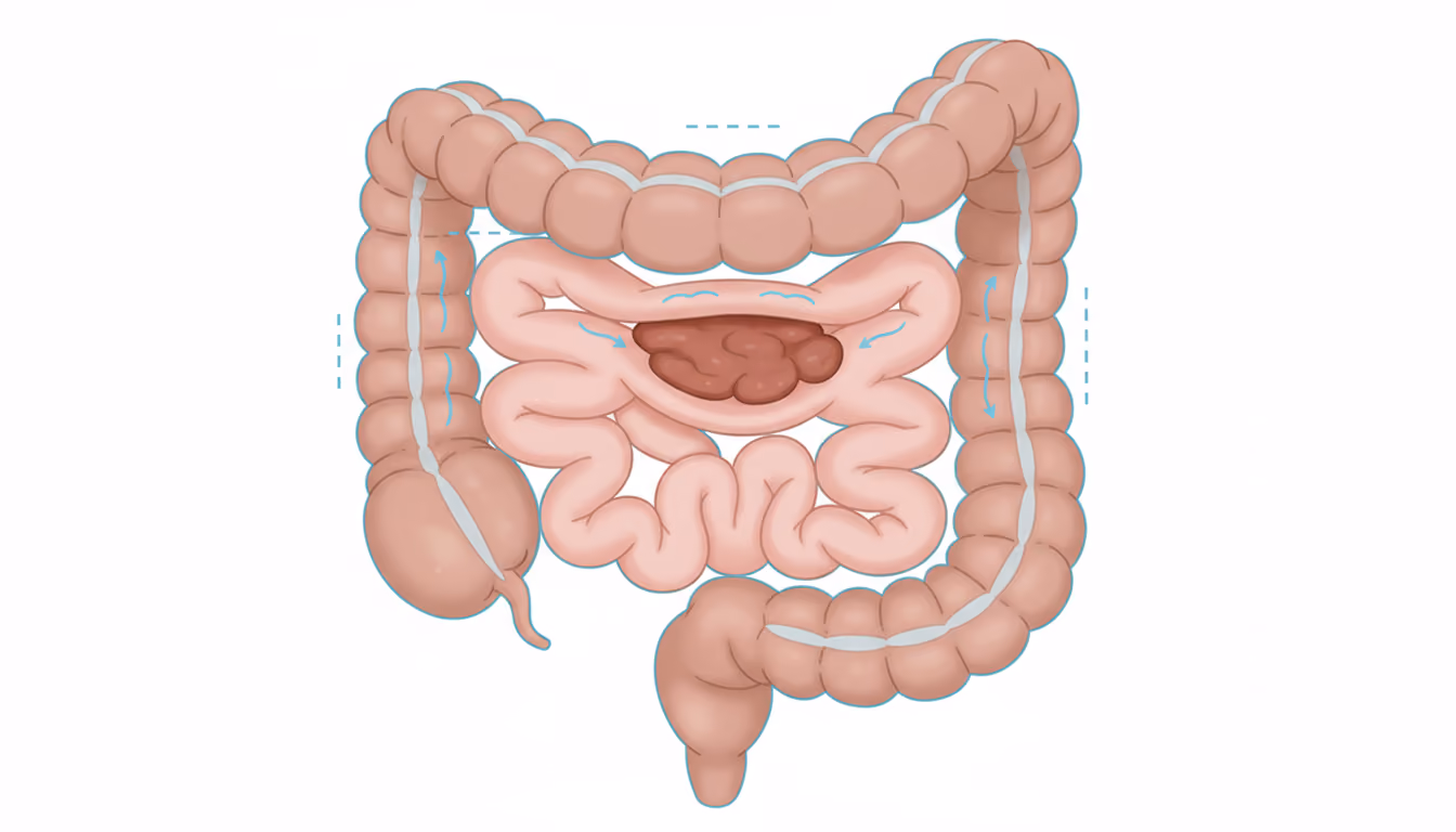 Paralytic ileus