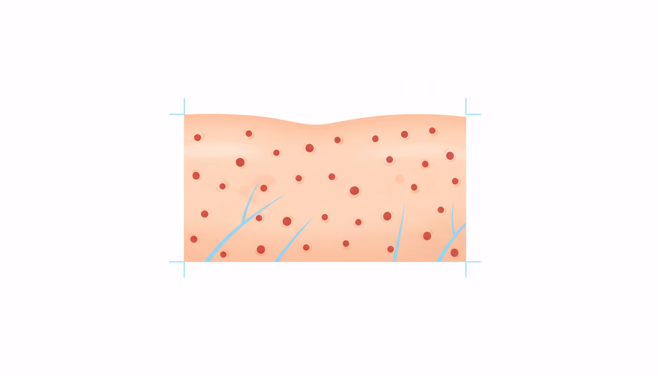 Petechiae