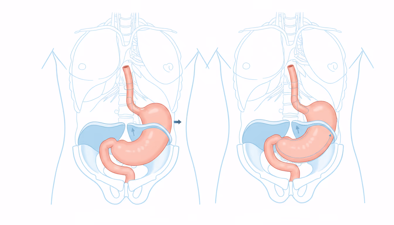Sliding hiatal hernia