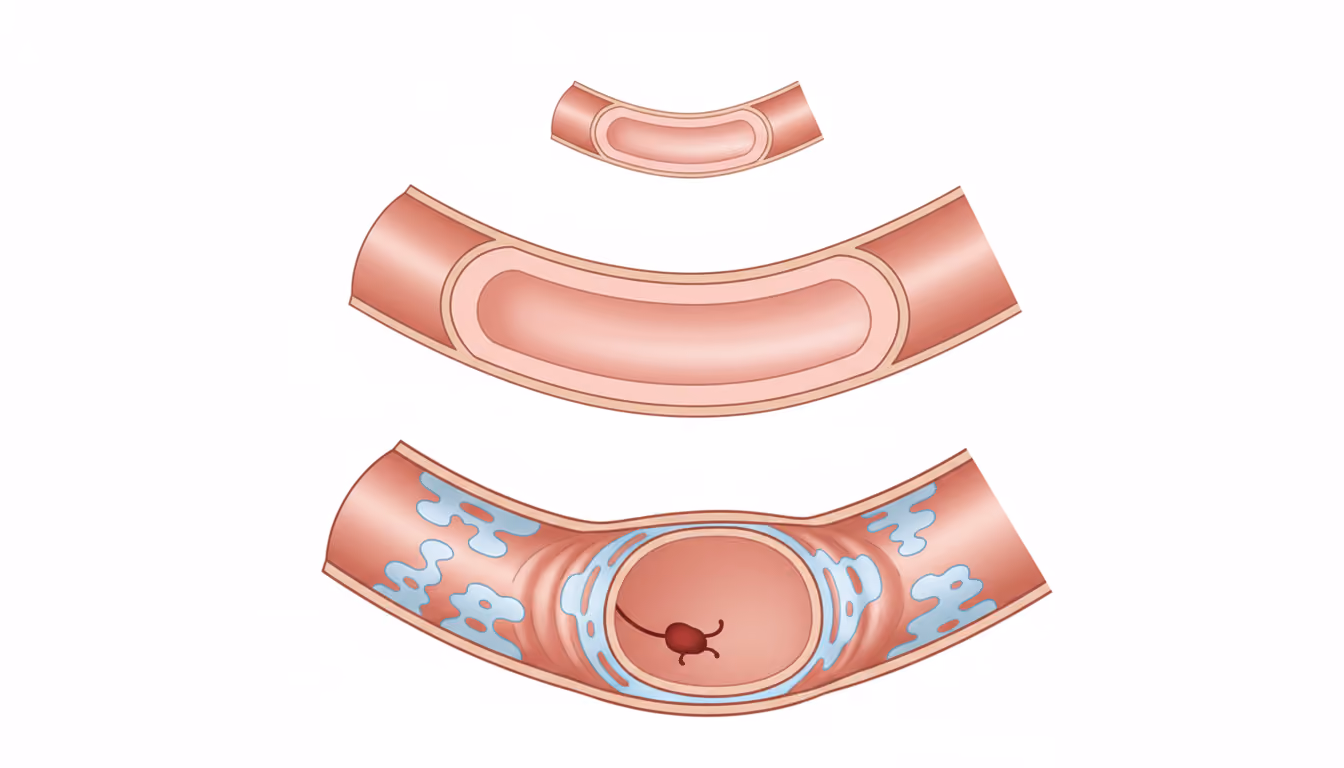 Vasculitis
