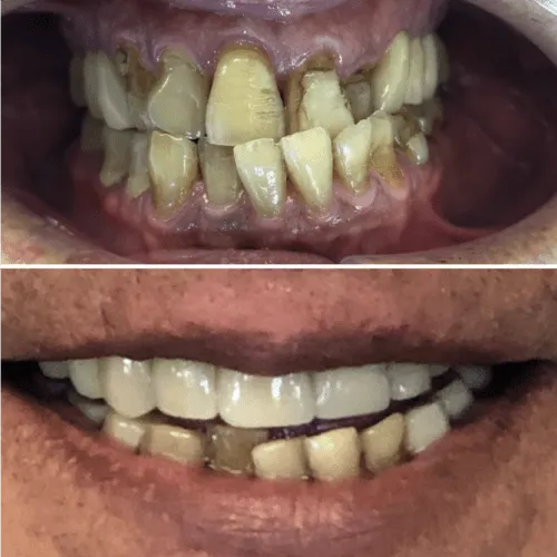 Close-up of teeth before and after dental treatment, showing improved alignment and color.