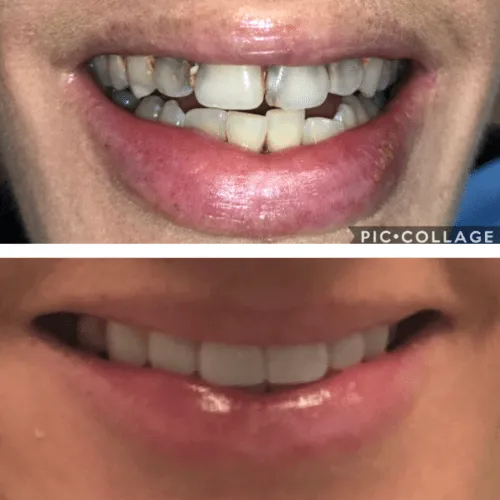 Close-up of a person's teeth before and after dental treatment, showing significant improvement.