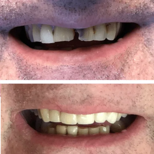 Two close-up images of a person’s mouth: top shows discolored teeth, bottom shows clean, white teeth.