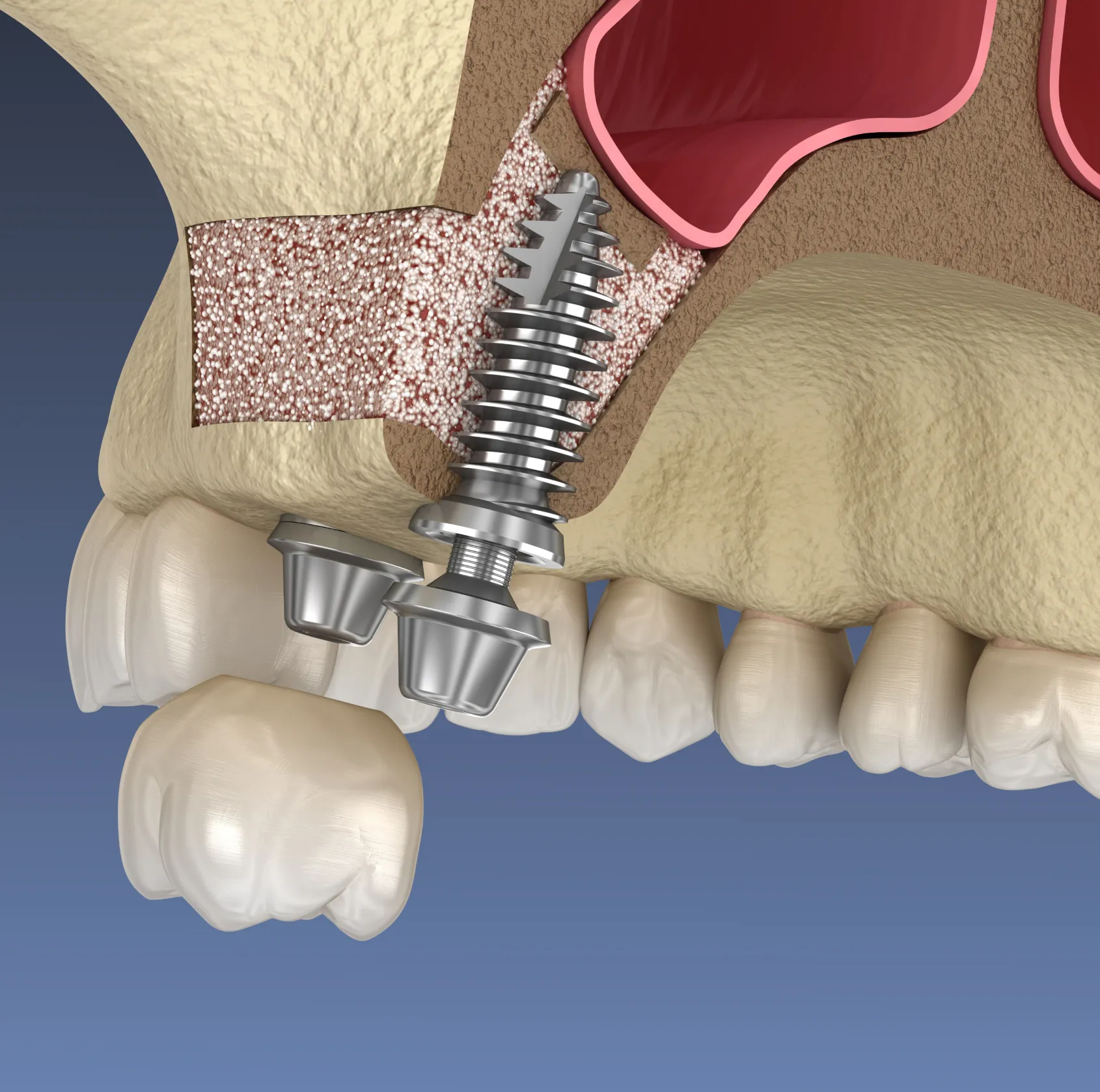 Illustration of a dental implant secured in the jawbone, showing surrounding bone graft material.