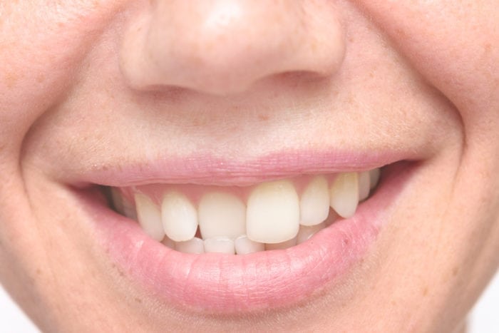 Treat Crooked Teeth in Marriottsville, Maryland