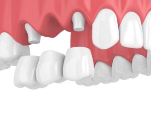 dental bridges Marriottsville Maryland