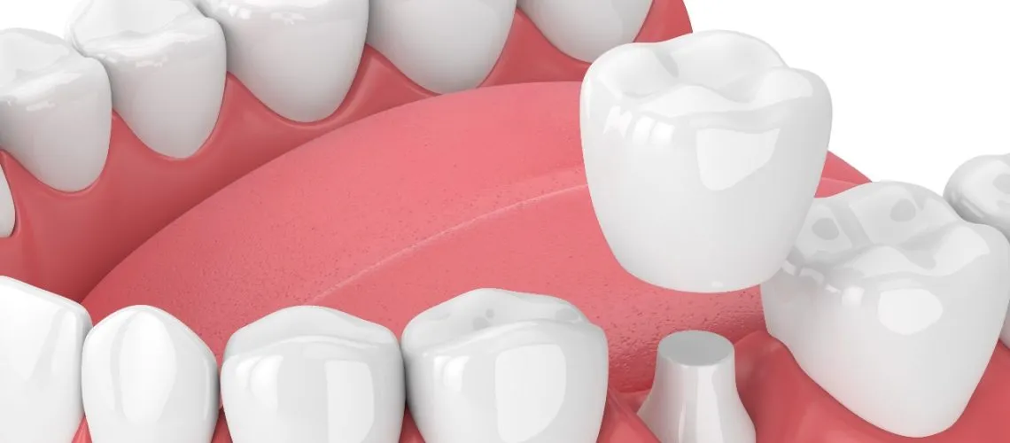 What are the Pros and Cons of Dental Crowns?
